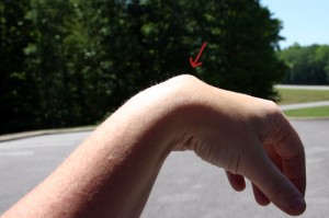 ganglion-cyst-on-wrist